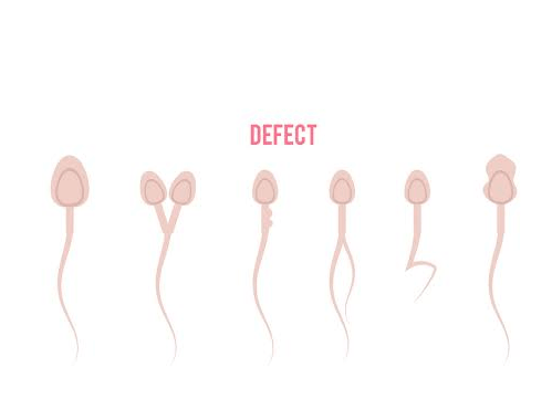 defective-sperm