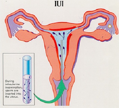 Intrauterine Insemination (IUI) with its treatment procedure