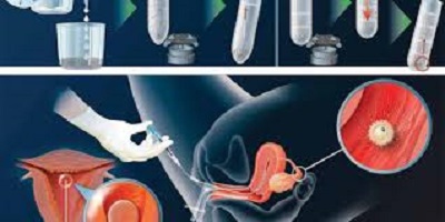 Learn about IUI with the best IVF centre in India