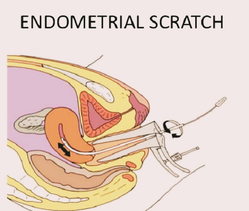 Know the importance of Endometrial Scratching with best IVF Centre in Siliguri