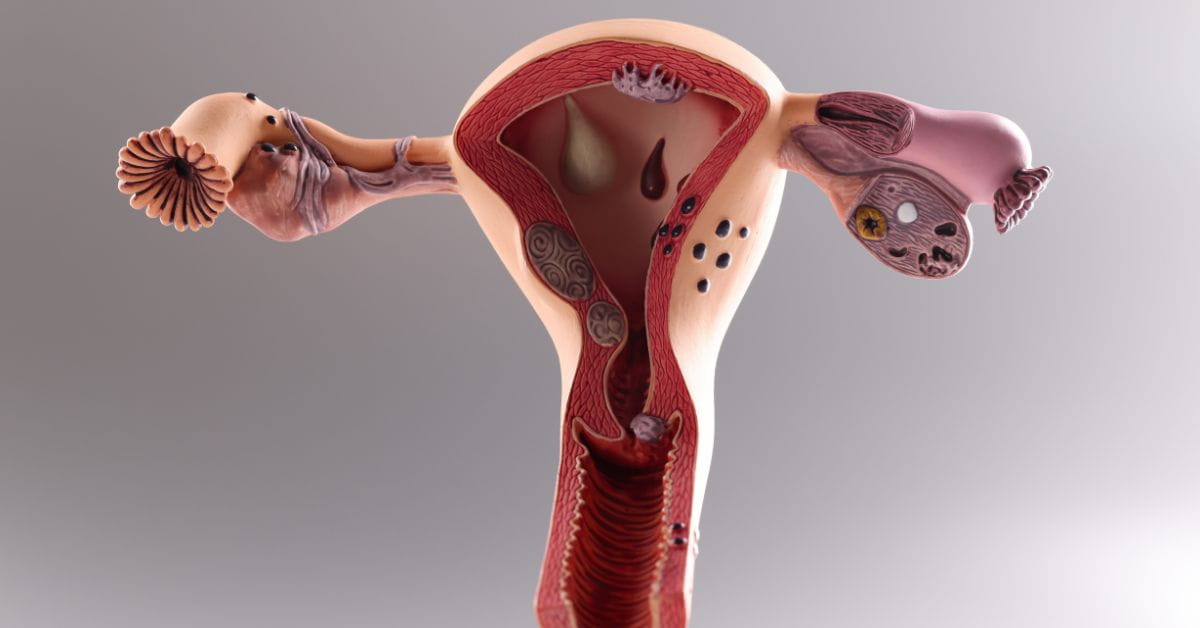 T Shaped Uterus - newlife Blog
