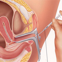 Intrauterine insemination (IUI)