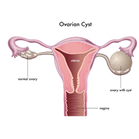 Laparoscopic cystectomy