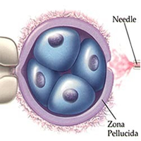 Laser Assisted Zona Hatching