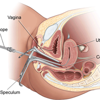 Hysteroscopic Polypectomy