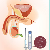 Testicular Sperm Aspiration