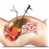 Diagnostic Laparoscopy