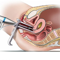 Diagnostic Hysteroscopy