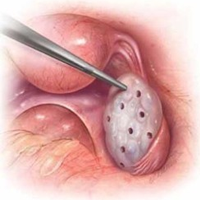 Laparoscopic Ovarian Drilling