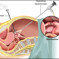 Laparoscopic Chromopertubation