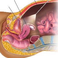 Laparoscopic myomectomy