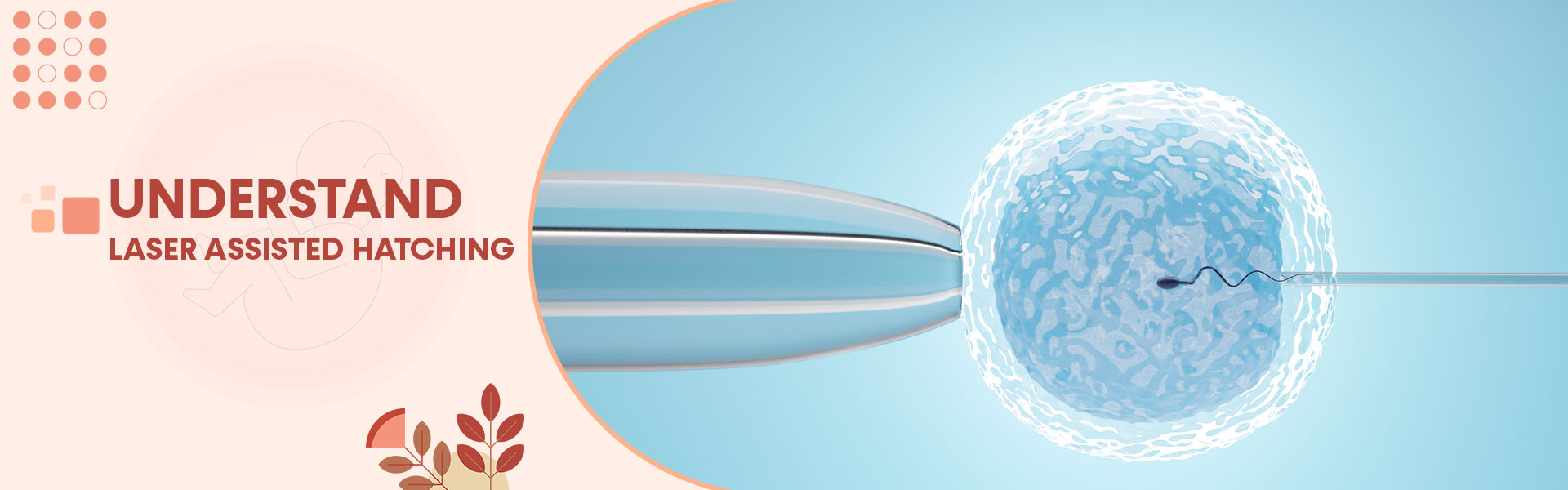 Laser Assisted Hatching