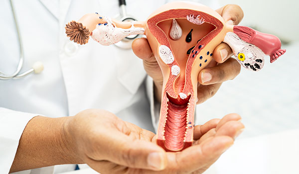 Polycystic Ovary Syndrome (PCOS)