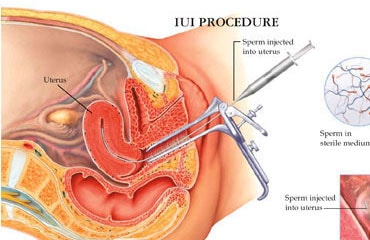 Intrauterine Insemination(IUI)